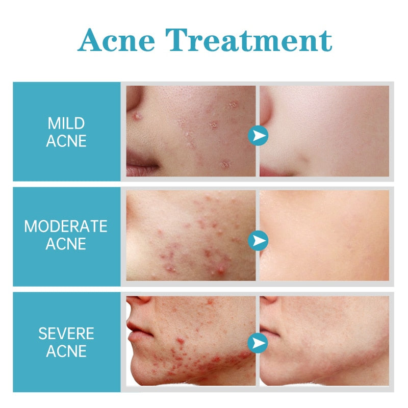 Acne Face Cream