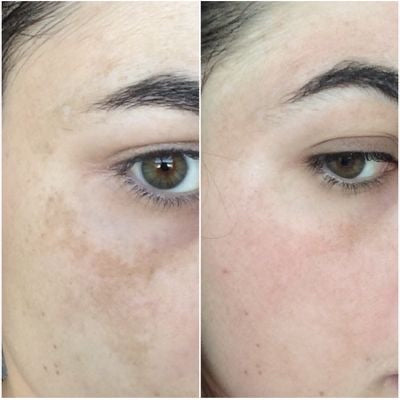 Melasma Removal Cream