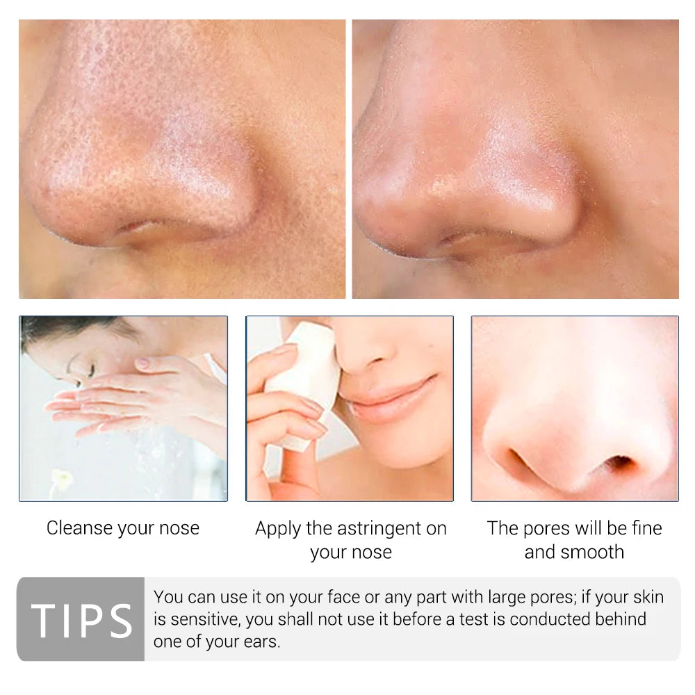 Acne Treatment Remover Nose Blackhead