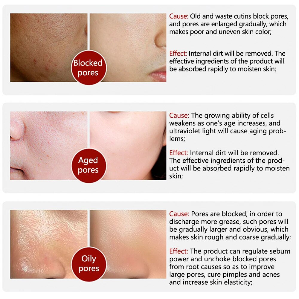 Acne Treatment Remover Nose Blackhead