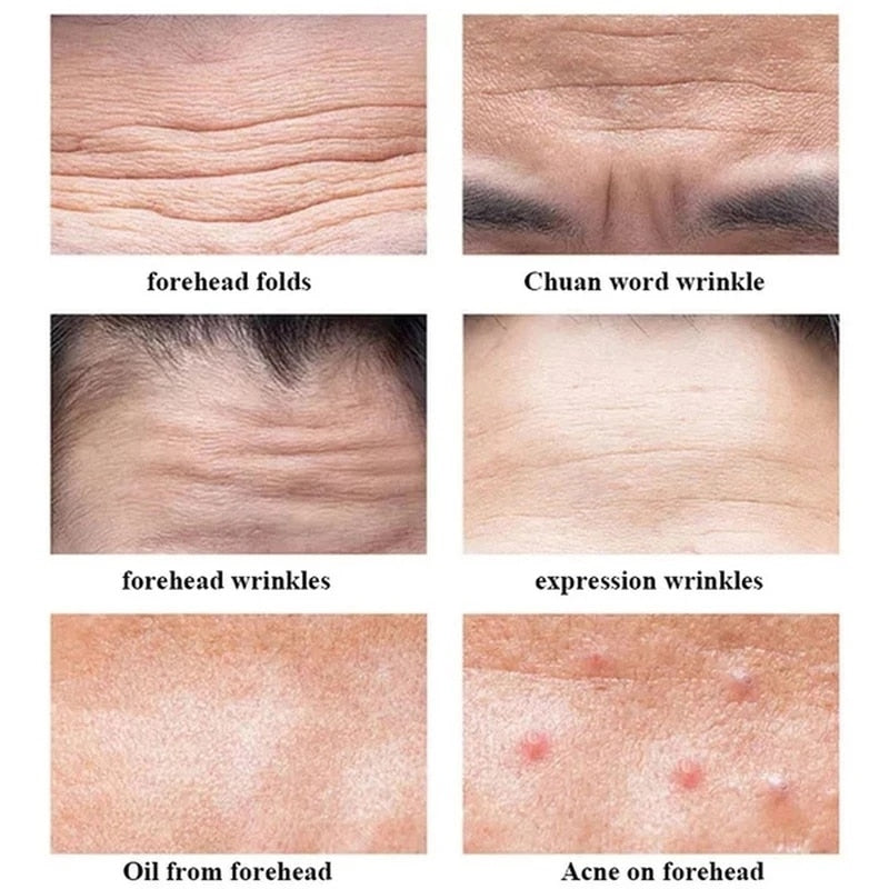 Anti-wrinkle Forehead Line Removal