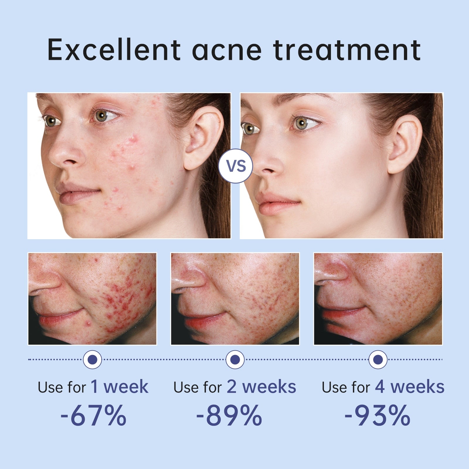 Herbal Acne Treatment