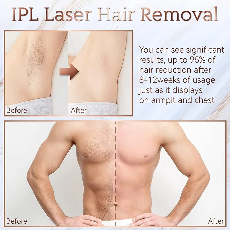 Hair Removal Laser